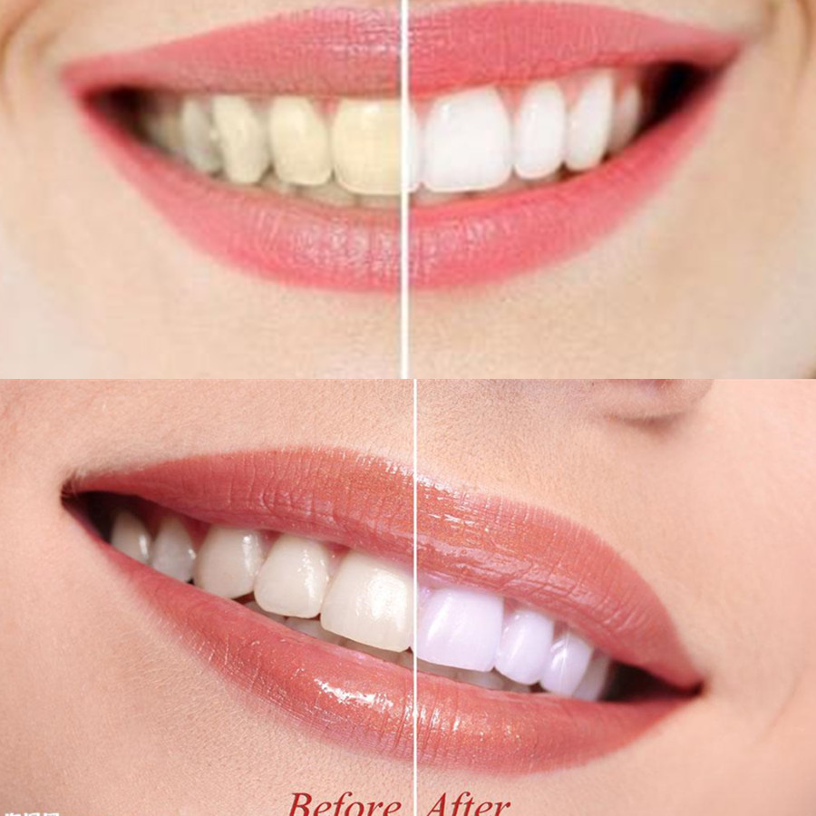 대나무 숯 치아 치아 Dentis Lab 구강 위생 관 - Teeth Whitening Yellow Teeth 리뷰 및 가격