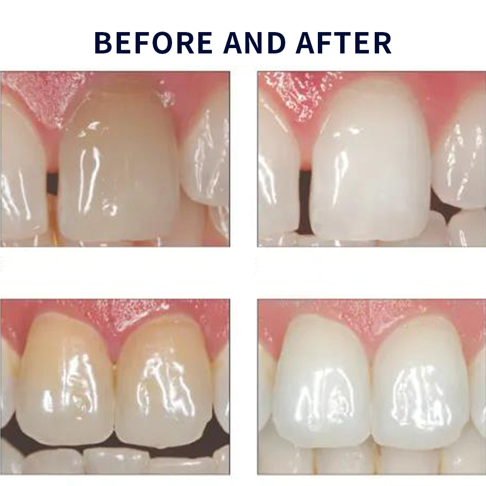 유백광 미백 20% PF 20 16 젤 키트, 초강력  - Teeth Whitening Paste 리뷰 및 가격